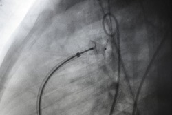 x ray image perform PDA device closure after treatment patent ductus arteriosus disease (PDA), which is congenital heart disease