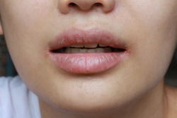close up of chapped, cracked lips caused wound on the corner of the lips: dry skin problem with mouth disease, Angular cheilitis
