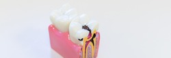 Dental decay model shows progress of decay.An example of dental disease. Dentistry. Caries on the tooth. Inflammation of the nerves of the teeth.Copy space. web banner