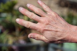 Elderly fingers and hands with osteoarthritis nodules and gangion cyst on knuckles and distal interphalangeal joints.