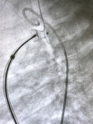 Patent ductus arteriosus (PDA), which is congenital heart disease, already closed by deployed PDA closure device via endovascular procedure