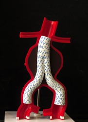 Model of aortic aneurysm that has treatment by endovascular fenestrated and branched stent grafts. Endovascular aortic aneurysm repair (EVAR)