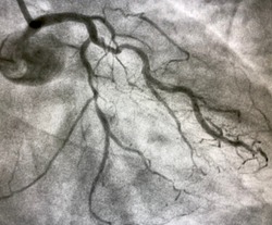 coronary angiogram showed chronic total occlusion (CTO) of left anterior descending artery (LAD)
