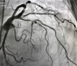 Coronary angiogram shown mid left anterior descending artery (LAD) stenosis during cardiac catheterization.