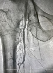 Right femoral artery angiogram at cardiac catheterization room.