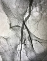 Right femoral artery angiogram at cardiac catheterization room.