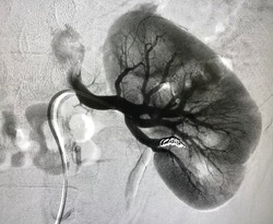 Angiogram shown renal artery with coil embolization.