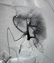 Angiogram shown renal artery after coil embolization procedure.