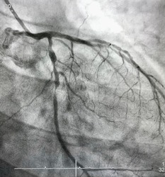 coronary angiogram of left coronary artery showed left circumflex artery (LCx) and left anterior descending artery (LAD) stenosis.