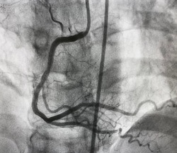coronary angiogram showed right coronary artery (RCA) given collateral to left anterior descending artery (LAD) that had chronic total occlusion (CTO).