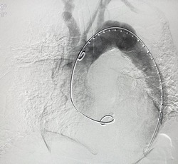 Angiogram of aorta shown aortic dissection type B at descending aorta during Thoracic endovascular aortic repair (TEVAR).