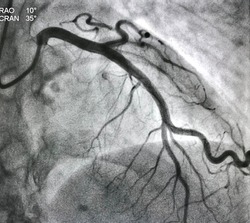 Normal left coronary artery angiogram.