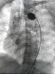 Stent graft balloon catheter was inflated after stent  graft deployed at descending aorta during Thoracic endovascular aortic repair (TEVAR).