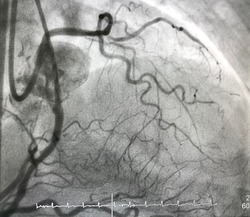 coronary angiogram in dual catheter angiography showed chronic total occlusion (CTO) of left anterior descending artery (LAD) with collateral from right coronary artery (RCA).