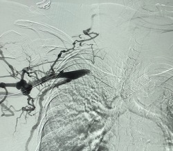 Peripheral vascular angiogram showed right subclavian artery stenosis.