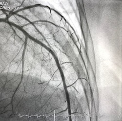 Normal left coronary artery angiography.
