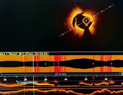 Intravascular imaging Optical Coherence Tomography (OCT) shown dissection in coronary artery.