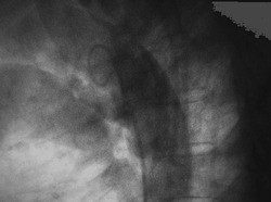 Aortography showed patent ductus arteriosus (PDA) in adult patient during PDA closure device via endovascular procedure.