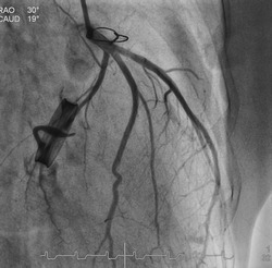 Coronary artery (CAG) was performed normal left coronary artery and prosthetic valve in patient post open heart surgery.