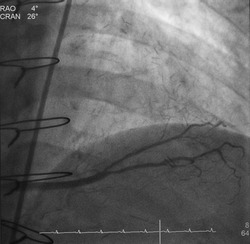 Coronary angiogram (CAG) was performed saphenous vein graft (SVG) to posterior lateral artery (PL) in patient post coronary artery bypass graft (CABG).