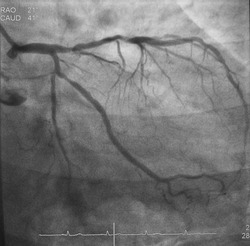 Coronary angiogram (CAG) was performed left anterior descending artery (LAD) and left circumflex artery (LCx) stenosis.