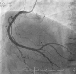 Coronary angiogram (CAG) was performed normal right coronary artery (RCA).