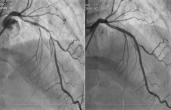 Comparison of pre-post percutaneous coronary intervention (PCI) at proximal to mid left anterior descending artery (LAD) with drug eluting stent (DES). 