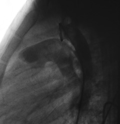 Aortogram was performed patent ductus arteriosus (PDA) opening between aorta and pulmonary artery in congenital heart disease.