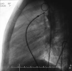 X ray image showed delivery catheter deployed device in patent ductus arteriosus (PDA) closure procedure.