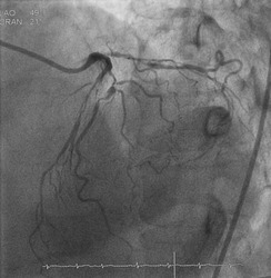 Coronary angiogram (CAG) was performed left anterior descending artery (LAD) stenosis and diagonal branch (DG) aneurysm.