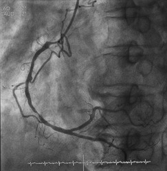Coronary angiogram (CAG) was performed right coronary artery (RCA) stenosis.