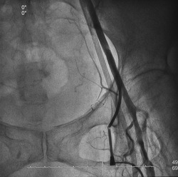 Peripheral angiogram was performed left femoral artery with introducer sheath kinking.