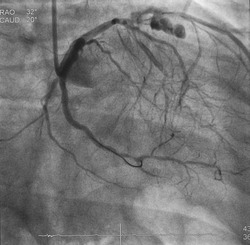 Coronary angiogram (CAG) was performed mid left anterior descending artery (LAD) perforation after percutaneous coronary intervention (PCI).