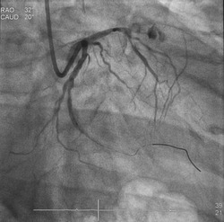 Coronary angiogram (CAG) was performed mid left anterior descending artery (LAD) perforation after percutaneous coronary intervention (PCI).