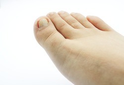 Bare foot without shoes or socks showing buried nail problems