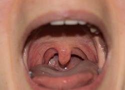 Closeup view of open mouth with tonsils