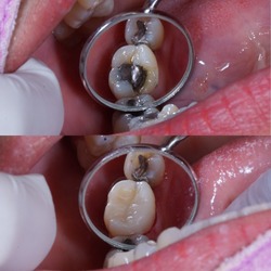 molar tooth show before and after filling