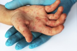 Viral Diseases. Hand infected. Hand foot and mouth disease HFMD. Allergic. Doctor and patient. Red rashes on the palm of the hand. Enterovirus . Coxsackie virus.