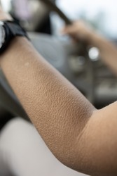 goose pimples close up - woman driving in car with skin reaction to cold