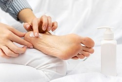Womans hand applies moisturizing nourishing cream to the heels of feet with dry cracked skin while sitting on a white bed. Home foot care and treatment for dermatitis, eczema, dryness.