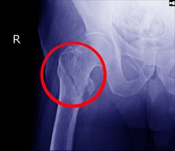  Hip fracture xray photo image.X-ray of hip joint fracture for elderly patient who falling in the step.