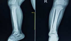 X-ray right leg a boy 3 year old.Showing fracture distal shaft tibia.