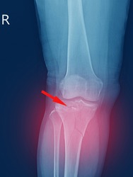 X-ray knee Fracture proximal metaphysis of tibia.Depressed fracture of lateral tibial plateau.severe swelling of soft tissue on red point .Medical healthcare concept.