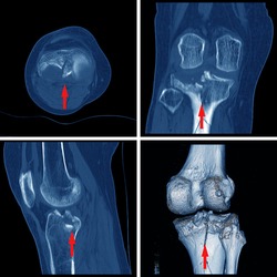 CT scan knee Fracture of intercondylar eminence of tibia. Compression fracture of posterior of lateral tibial plateau which involved articular surface.Medical image concept.