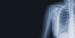 x-ray images of the shoulder joint to see injuries bones and tendons for a medical diagnosis.Medical image concept and copy space.