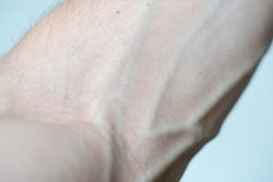 Large bulging veins and arteries on a man's arm close up. Varicose veins. Elbow bend.