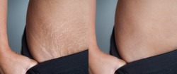 Image before and after skin stretch marks removal treatment. 