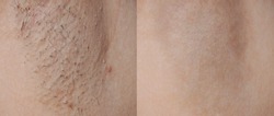 Close-up before and after skincare cosmetology armpits epilation treatment concept. Problem underarm chicken skin, Fox Fordyce, black armpit in woman texture background . 