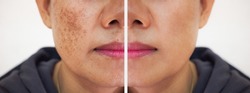 Problem skincare and health concept.Wrinkles,melasma,Dark spots,freckles,dry skin on face middle age woman. Before and after treatment.