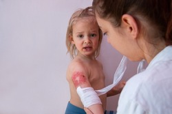 Child burn injury, burns treatment and healing, pediatrician is dressing wound on toddler arm with a sterile non-adhesive bandage
